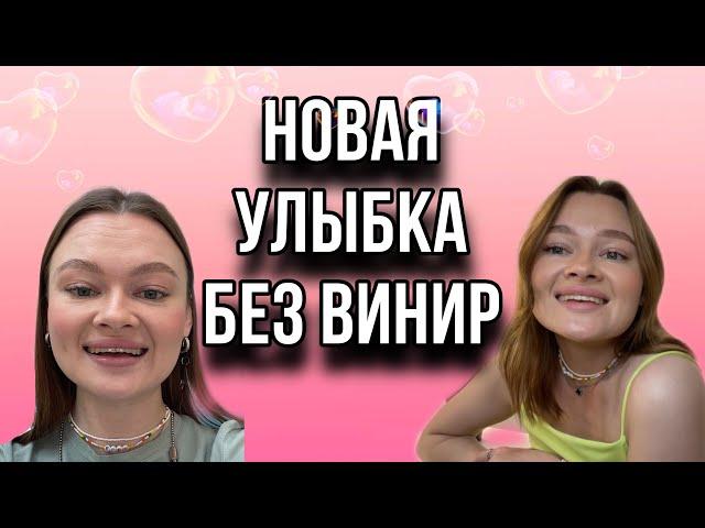 НАРАЩИВАНИЕ ЗУБОВ | БЕЗ ВИНИР  | ЧТО ЭТО | ЦЕНЫ