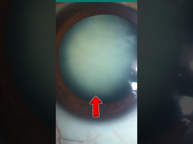 What Does a Cataract Look Like Inside Your Eye? (Visual Representation)