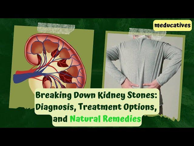 Breaking Down Kidney Stones Diagnosis, Treatment Options, and Natural Remedies