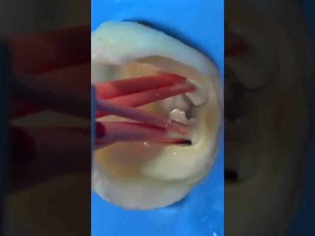 Root canal filling and fixed crown + dental implant
