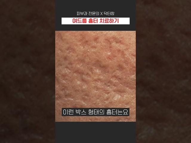 여드름 흉터 치료하는 방법! #여드름 #여드름흉터 #피부관리 #꿀팁