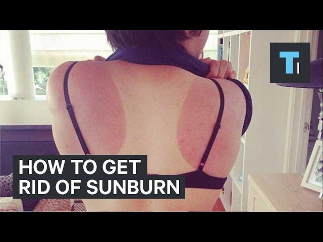 How to get rid of sunburn