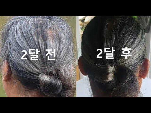 2달 후 머리숱이 많아지고 흰머리가 검은 머리로 변했습니다. 초주파발마사지 2달 사용 후기.