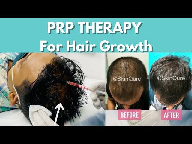 PRP THERAPY FOR HAIR LOSS #shorts #prp