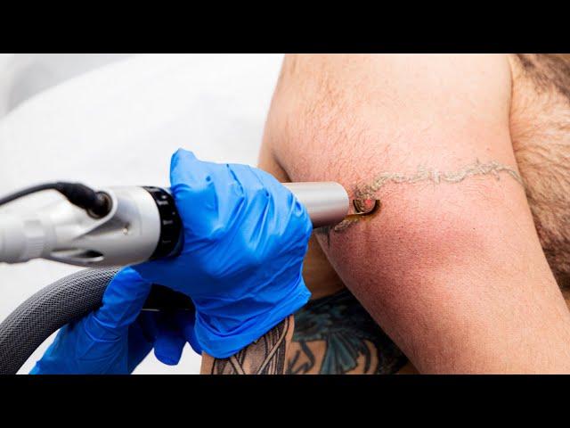 How does laser tattoo removal work?