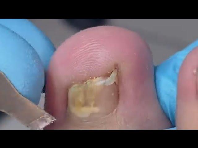 Nail almost go through toe