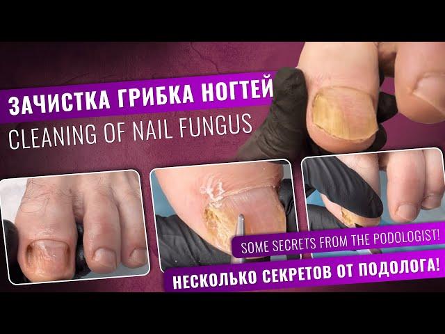 Зачистка грибка ногтей. Несколько секретов от подолога! @Podolog__eva