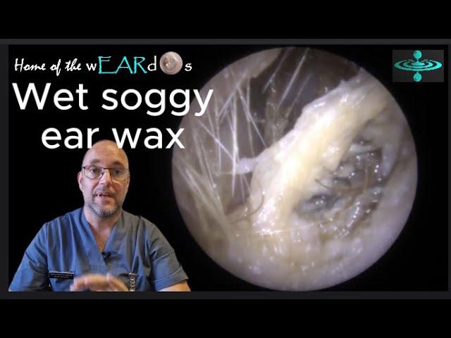 Wet soggy ear wax - Episode 118 #ear #earwax #earwaxremoval #earcleaning #earwaxclinic