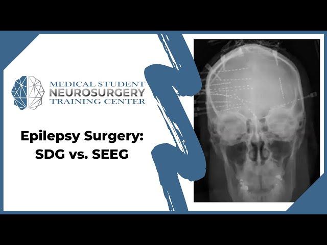 Epilepsy Surgery: SDG vs. SEEG