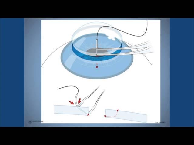 Corneal Suturing, Part 1- A Curriculum for Suturing the Cornea