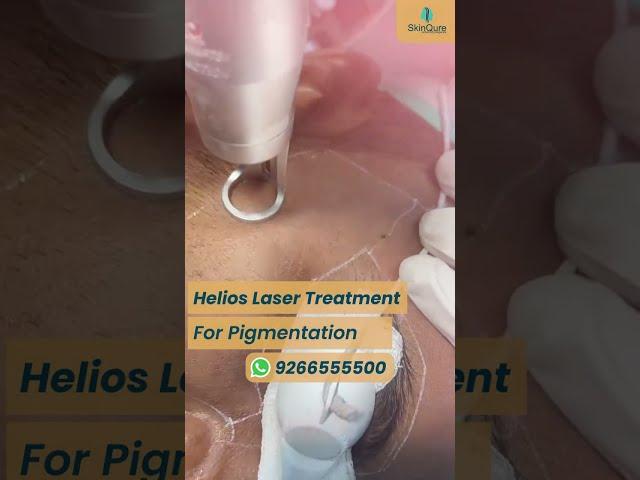 Helios laser treatment for Pigmentation | Removes Dark Spots & Blemishes at @skinqure  | Delhi