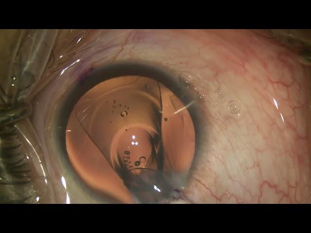 Implantable Collamer Lens(ICL) surgery