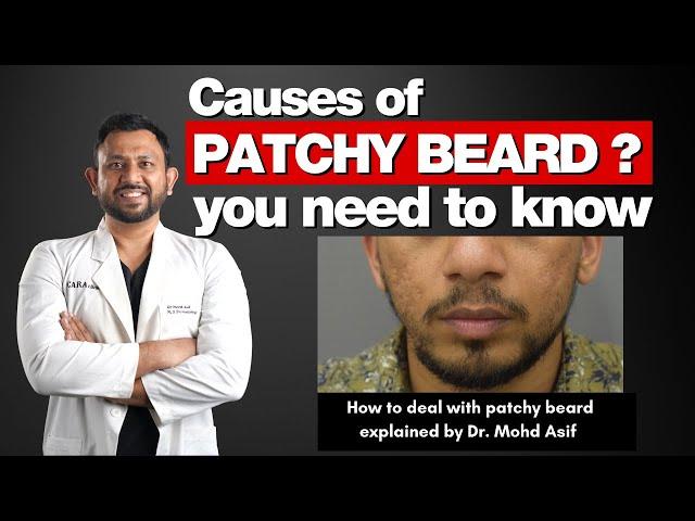 Patchy Beard Causes | Solutions | Treatments To Deal with Patchy Beard