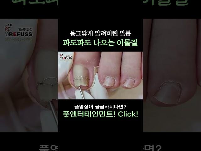 동그랗게 말려버린 통증 내성발톱!! 파도파도 나오는 이물질!? #레푸스 #일산레푸스 #내성발톱 #무좀발톱 #ingrown_toenail #일산내성발톱 #일산무좀발톱 #발톱