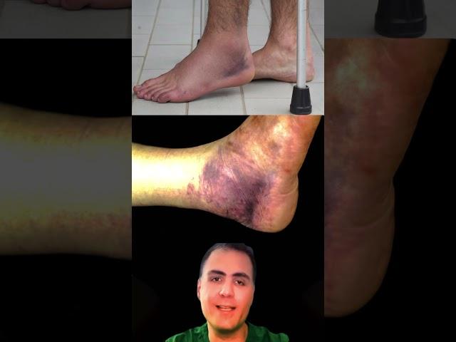 Ankle Fracture