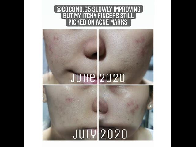 Testimonial by Jocelyn, a beloved consumer of Cocomo, who has found solution to her skin problems!