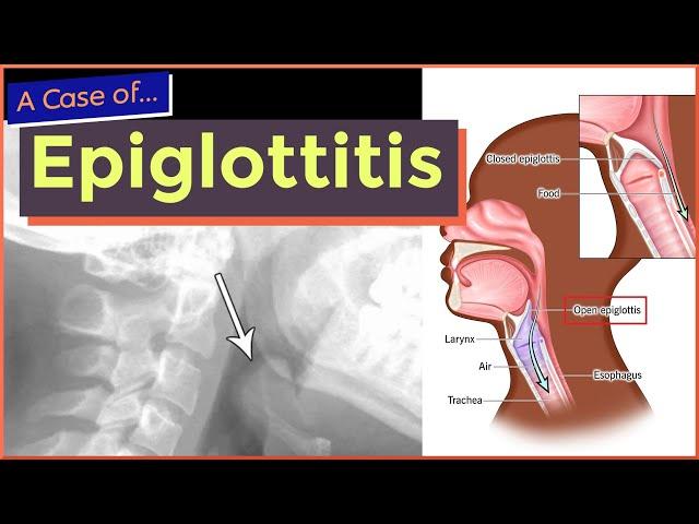 Epiglottitis