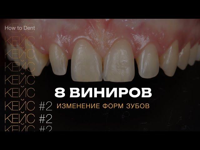 Изменение формы зубов. Виниры. Шиловидные зубы | Прокопович Виктор.