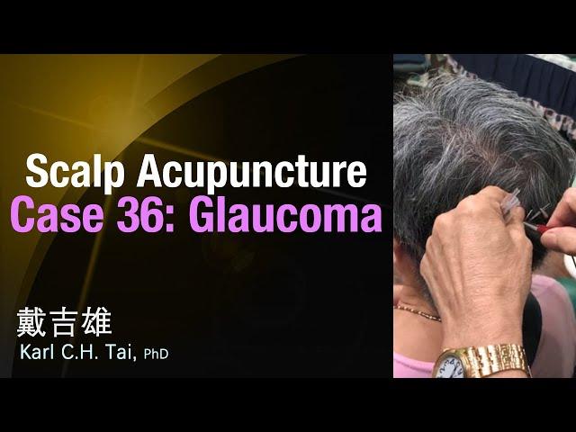 Tai's Scalp Acupuncture - Case 36: Glaucoma