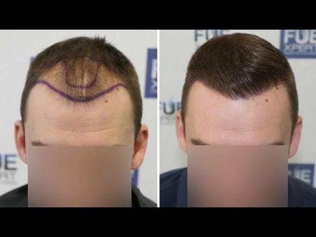 FUE Hair Transplant (2700 Grafts in NW-Class lll-A) Dr. Juan Couto - FUEXPERT CLINIC- Madrid, Spain