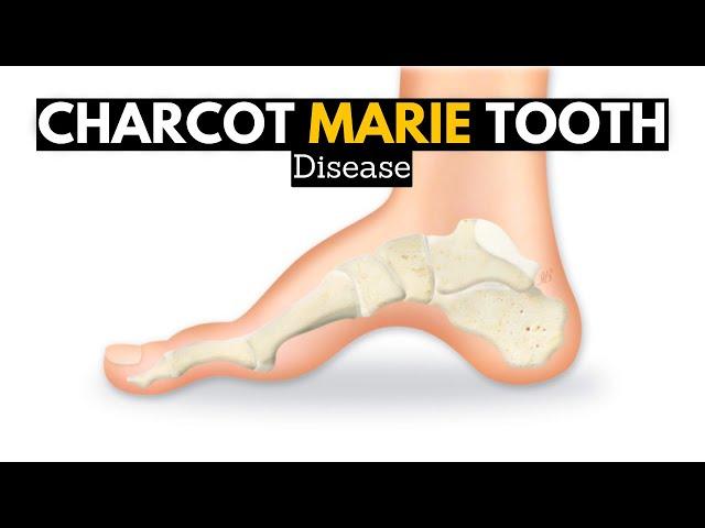 CHARCOT MARIE TOOTH DISEASE (CMT)