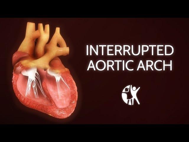 Interrupted Aortic Arch − Ventricular Septic Defect