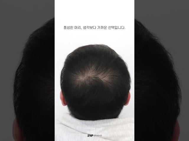 탈모 3번만에 가리기 #탈모 #인천두피문신 #두피문신 #smp