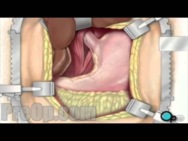 Hernia - Hiatal Open Repair Surgery - PreOp® Patient Engagement and Education