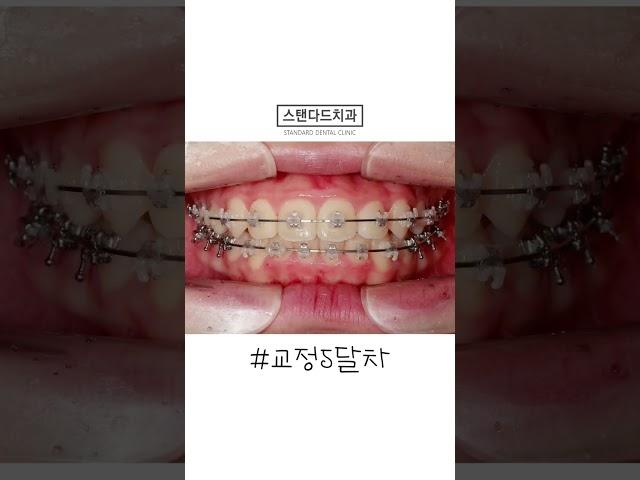 치아교정 5개월만에 거의다끝남!#shorts #치과 #뉴진스