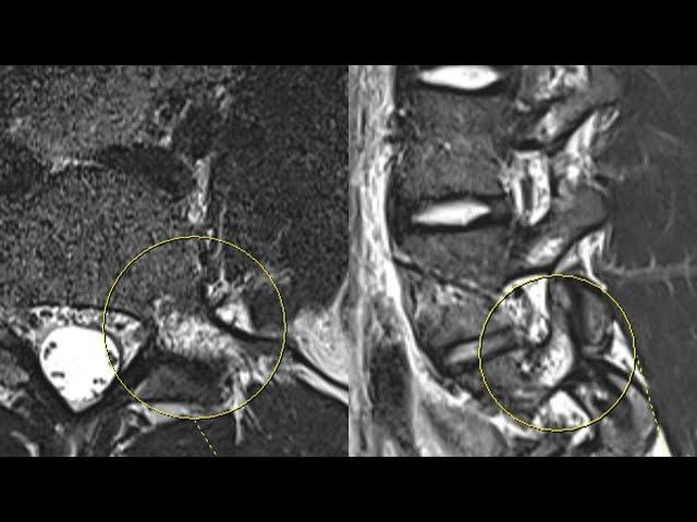 Pars Stress Reaction with Dr. Giuffrida