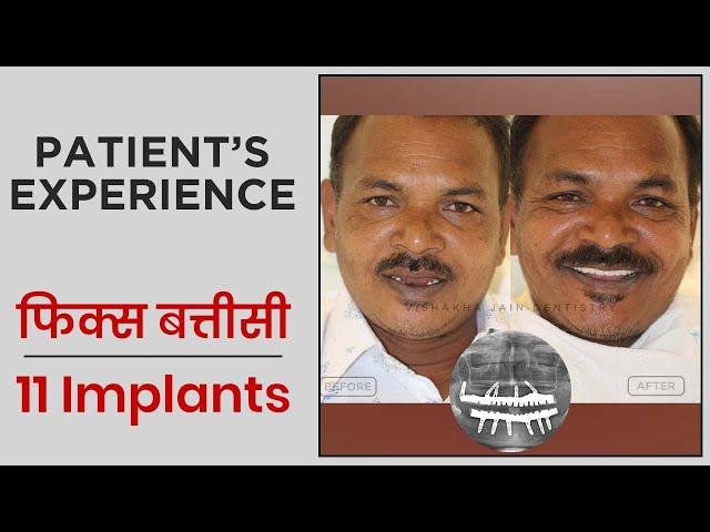 फिक्स बत्तीसी (11 implants)| Best Dentist in Indore | Patient Experience | Seraphic Dental Indore