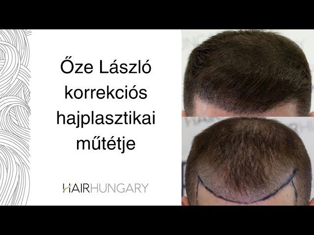 Őze László korrekciós hajplasztikai műtétje