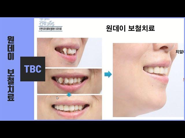 원데이 앞니 심미 보철 . Oneday Esthetic Dental treatment of Anterior tooth, Điều trị thẩm mỹ của răng trước