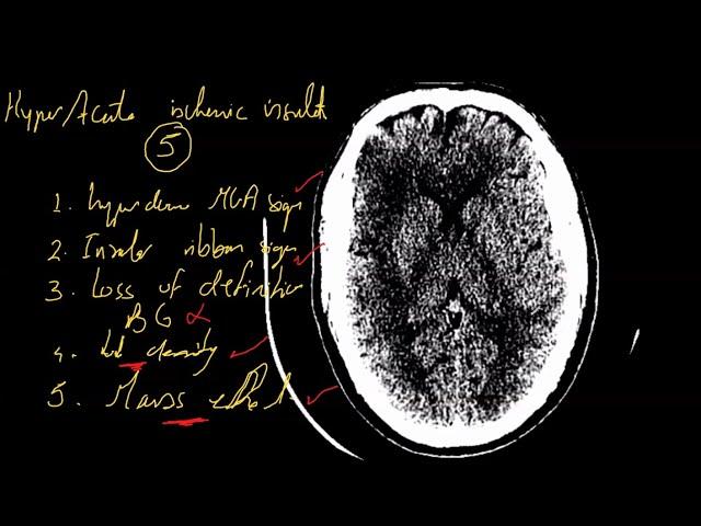 Case #20 (Emergency CT brain course)