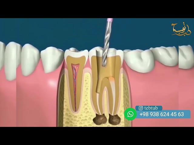 فيديو علاج العصب الاسنان و حشو الجذور الاسنان | طب الاسنان في ايران  |  طب توب