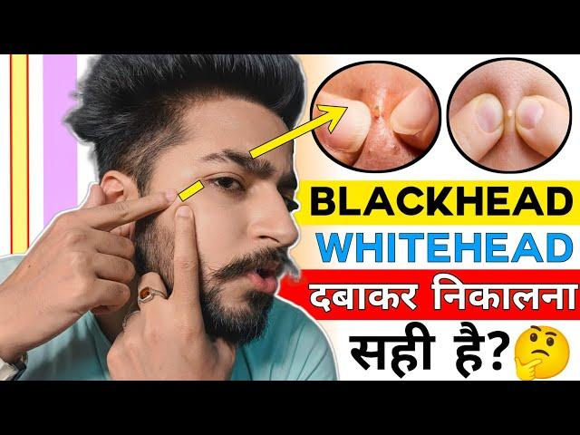 Blackhead, Whitehead को दबाकर निकालना सही है ? | Blackheads Popping Side Effects