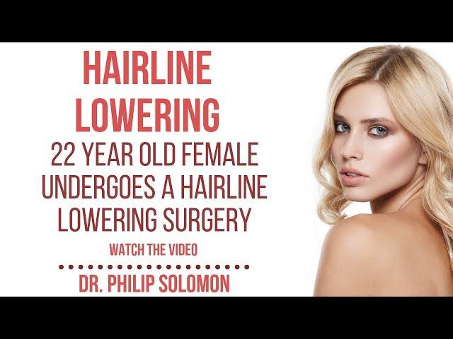 Graphic: Hairline Lowering On 22 Year Old Transgender Patient | Dr. Philip Solomon