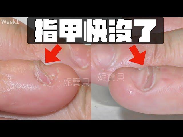 Severe nail strain｜Nails are almost gone｜Nails grow back after gel protection