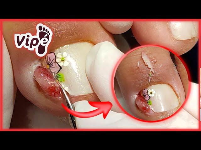 NAIL INFECTION SOLUTION  (OVERGROWN INFECTED INGROWN TOENAIL REMOVAL)