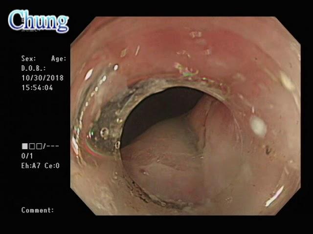 POEM for esophageal achalasia