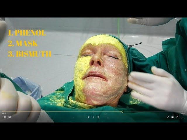 DEEP PHENOL PEELING - SHEILA´S STORY #2