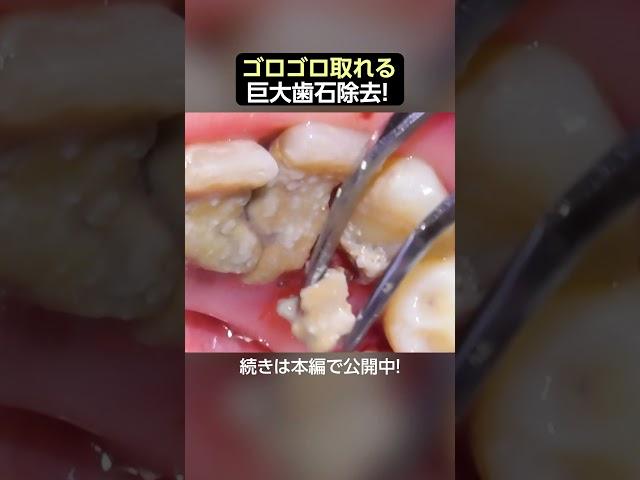 【歯石除去】歯石を蹴散らして口内の平和を取り戻せ‼️#歯医者 #歯石除去 #dentist #ザホワイトデンタルクリニック