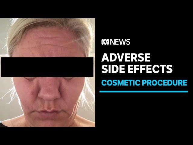 Patients report side effects after popular cosmetic procedure to dissolve facial fillers | ABC News