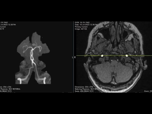 Basilar artery fenestration