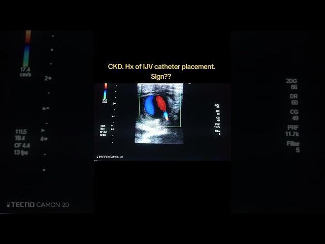 Pseudoaneurysm Common carotid artery.