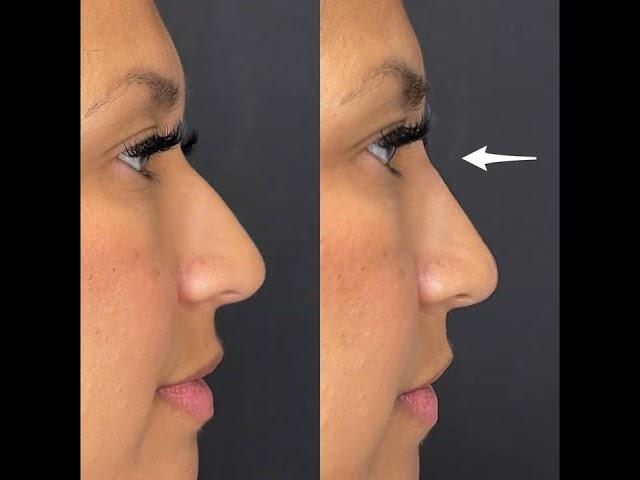 Non-Surgical Nose Job / Nose Filler from Dr. Tsay - Ageless MD