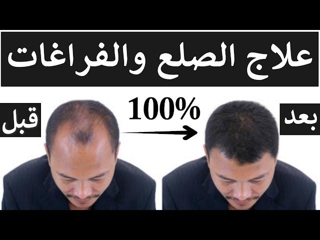 علاج الصلع عند الرجال| تساقط الشعر| الفراغات| تكثيف ومنع تساقط الشعر عند النساء