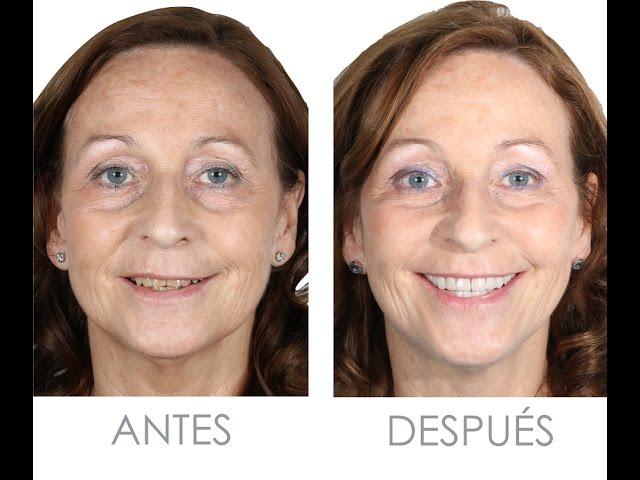 CARILLAS ULTRAFINAS PARA CAMBIO RADICAL DE ESTÉTICA DENTAL