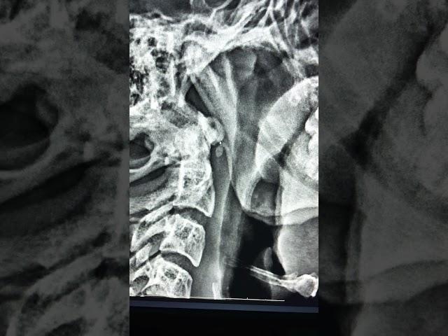 Accessory ossicle of Anterior arch of atlas - Normal variant