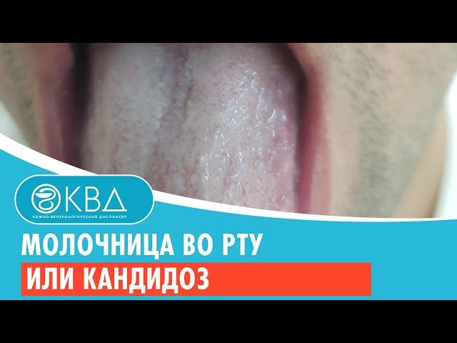 Молочница во рту или кандидоз. Клинический случай №107